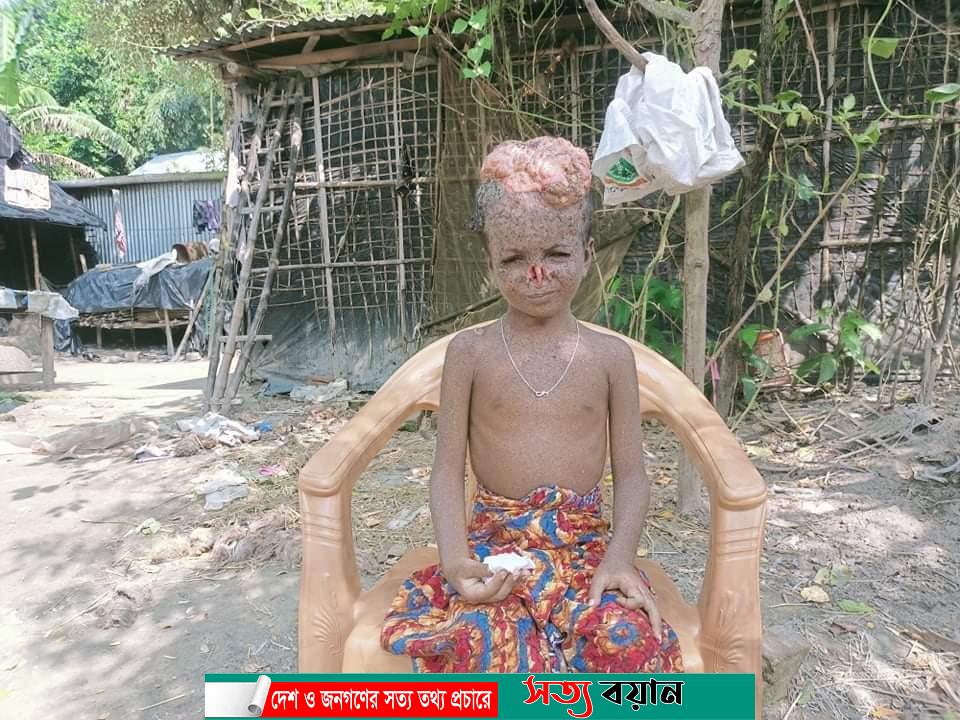 বিরল রোগে আক্রান্ত  চিকিৎসা হলে বাঁচবে শিশু সালমান-সত্যবয়ান